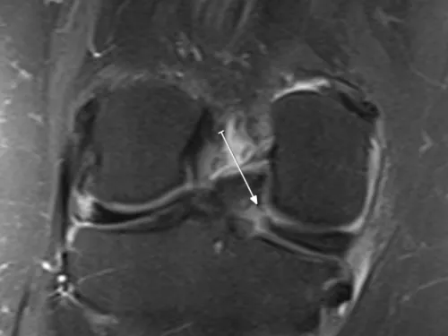 Raiz meniscal